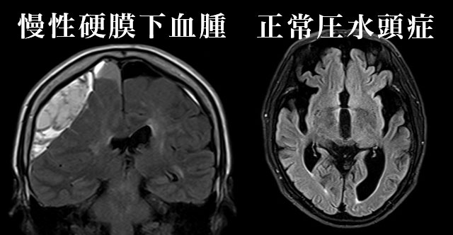 認知症脳ドック3テスラ(早期認知症チェックつき)